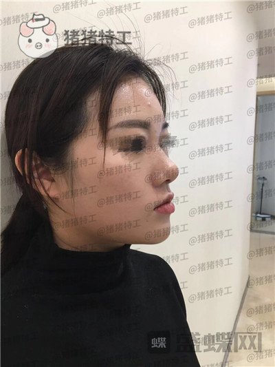 南京华韩奇致,裴柄万,隆鼻,案例,价格,