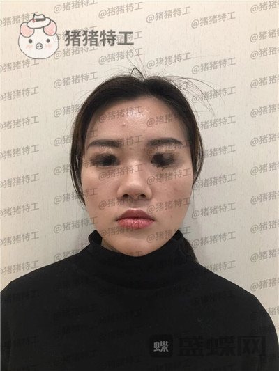 南京华韩奇致,裴柄万,隆鼻,案例,价格,