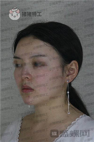 四川友谊,张立天,颧骨,磨骨术,案例,价格,