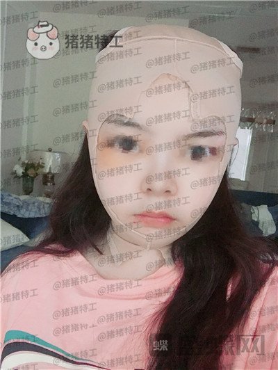 四川友谊,张立天,颧骨,磨骨术,案例,价格,