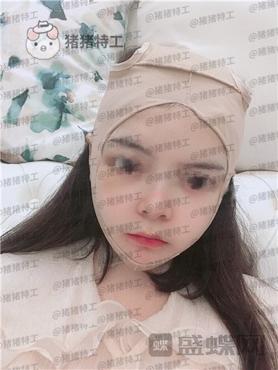 四川友谊,张立天,颧骨,磨骨术,案例,价格,