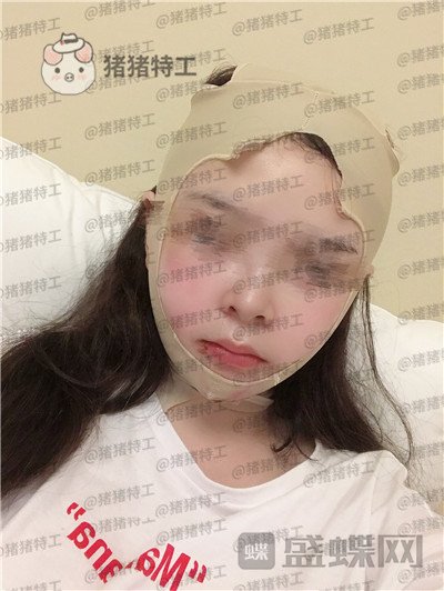 四川友谊,张立天,颧骨,磨骨术,案例,价格,