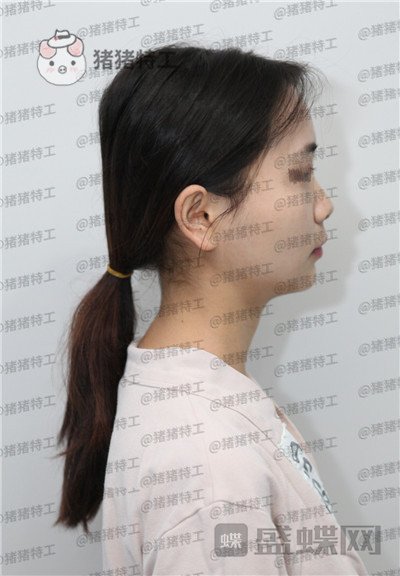 重庆铂生,杜亚旭,隆鼻,案例,价格,