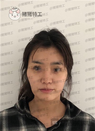 上海愉悦美联臣,陈红梅,面部填充,案例,价格,