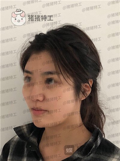 上海愉悦美联臣,陈红梅,面部填充,案例,价格,