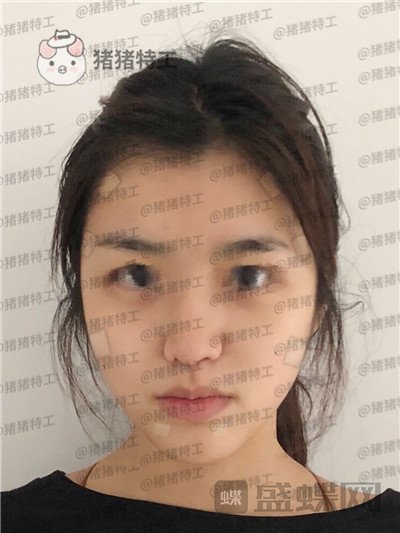 上海愉悦美联臣,陈红梅,面部填充,案例,价格,