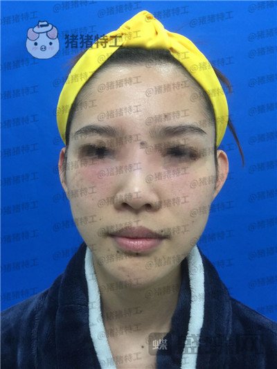 福州星龄,黎护忠,面部填充,案例,价格,