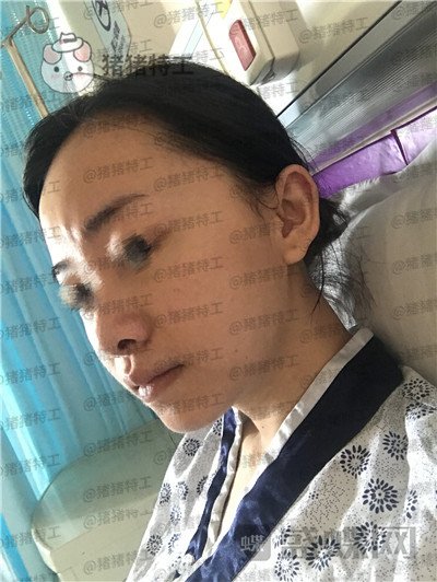 广州美莱,张毓,面部填充,案例,价格,