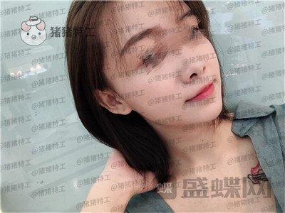 广州美莱,张毓,面部填充,案例,价格,