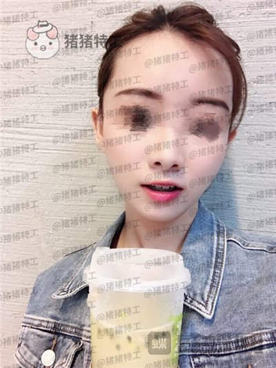 广州美莱,张毓,面部填充,案例,价格,