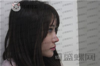 成都西区医院,肖凌,鼻部手术,案例,价格,