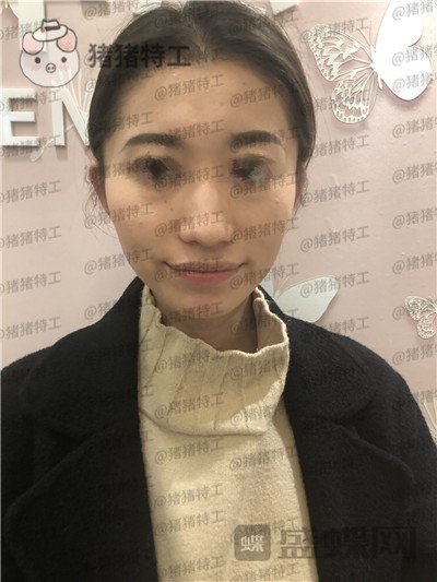 青岛诺德,姜留刚,面部填充,案例,价格,