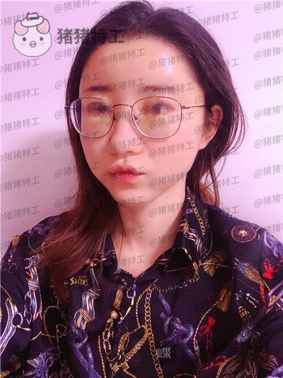 青岛诺德,姜留刚,面部填充,案例,价格,