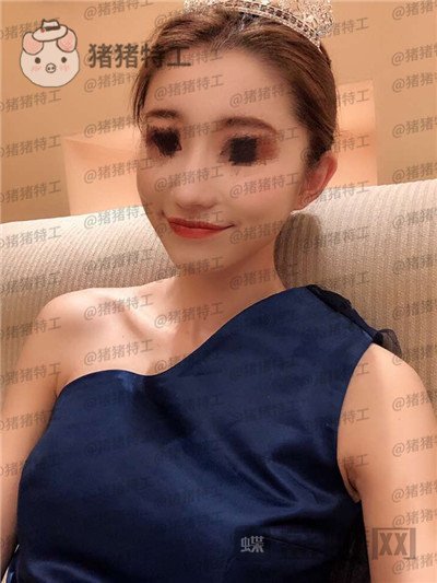 青岛诺德,姜留刚,面部填充,案例,价格,