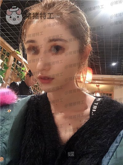 青岛诺德,姜留刚,面部填充,案例,价格,
