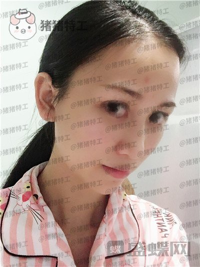 广州曙光,蒋思军,隆鼻,案例,价格,
