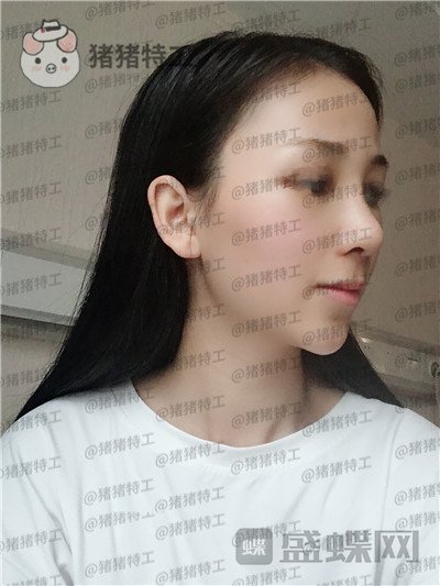 广州曙光,蒋思军,隆鼻,案例,价格,