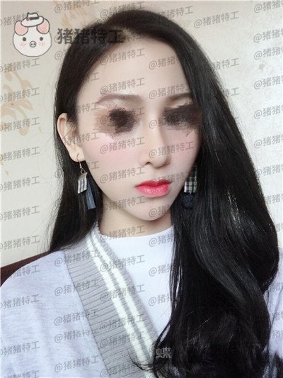 广州曙光,蒋思军,隆鼻,案例,价格,