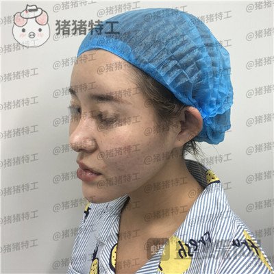 天津菲丝澜,刘贝,隆鼻,案例,价格,