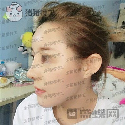 天津菲丝澜,刘贝,隆鼻,案例,价格,