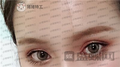 南京美贝尔,黄名斗,双眼皮,案例,价格,