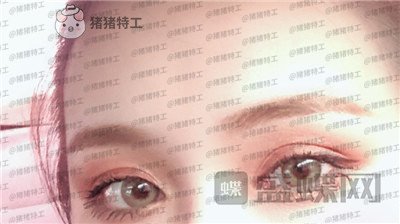 南京美贝尔,黄名斗,双眼皮,案例,价格,