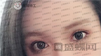 南京美贝尔,黄名斗,双眼皮,案例,价格,
