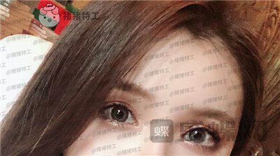 南京美贝尔,黄名斗,双眼皮,案例,价格,