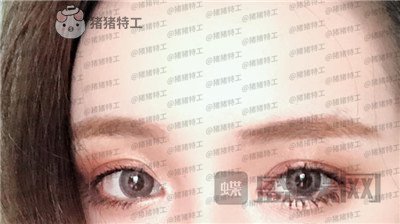 南京美贝尔,黄名斗,双眼皮,案例,价格,