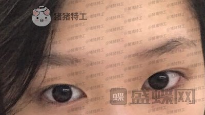 重庆美仑美奂,董祥宁,双眼皮,案例,价格,