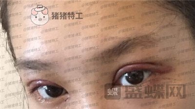 重庆美仑美奂,董祥宁,双眼皮,案例,价格,