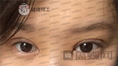 重庆美仑美奂,董祥宁,双眼皮,案例,价格,