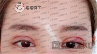 深圳美莱,周洪超,双眼皮,案例,价格,