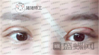 深圳美莱,周洪超,双眼皮,案例,价格,