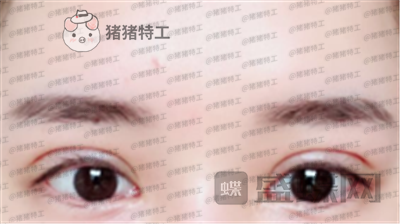 深圳美莱,周洪超,双眼皮,案例,价格,