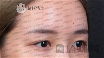 深圳美莱,周洪超,双眼皮,案例,价格,