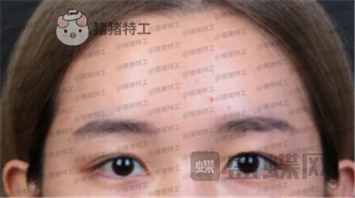 深圳美莱,周洪超,双眼皮,案例,价格,