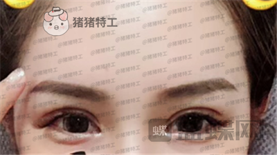 深圳美莱,周洪超,双眼皮,案例,价格,