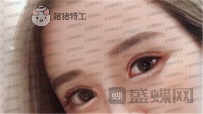 深圳美莱,周洪超,双眼皮,案例,价格,
