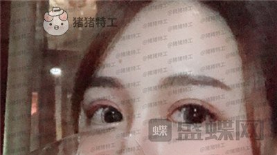 深圳美莱,周洪超,双眼皮,案例,价格,