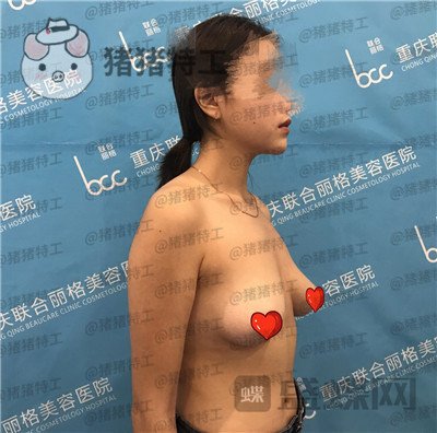 重庆联合丽格,党宁,隆胸,案例,价格,