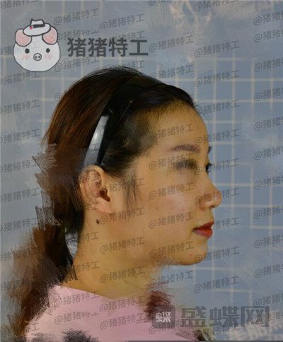 南宁美丽焦点,焦俊光,鼻部手术,隆鼻,案例,价格,