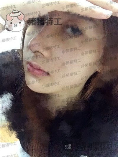 南宁美丽焦点,焦俊光,鼻部手术,隆鼻,案例,价格,