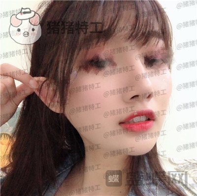 南宁美丽焦点,焦俊光,鼻部手术,隆鼻,案例,价格,