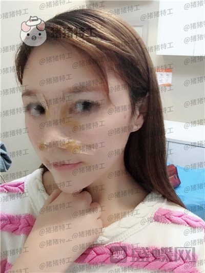 重庆中民,孙刚,隆鼻,案例,价格,