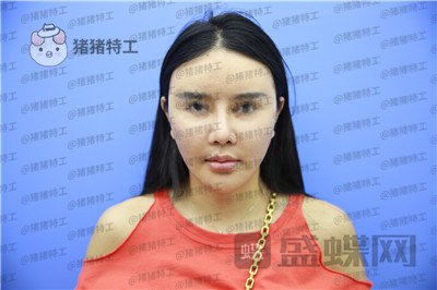 上海喜美,王会勇,隆鼻,鼻修复,案例,价格,