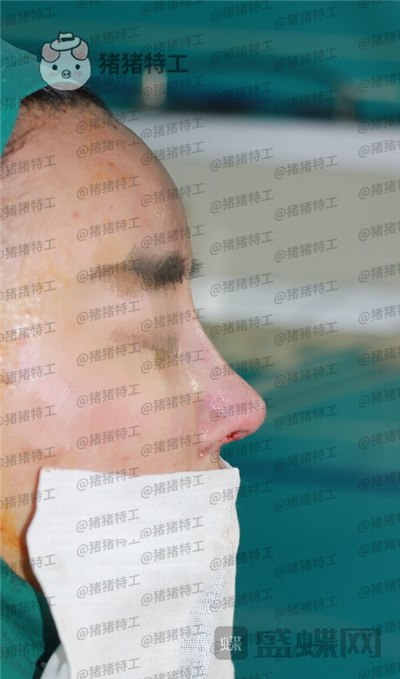 上海喜美,王会勇,隆鼻,鼻修复,案例,价格,