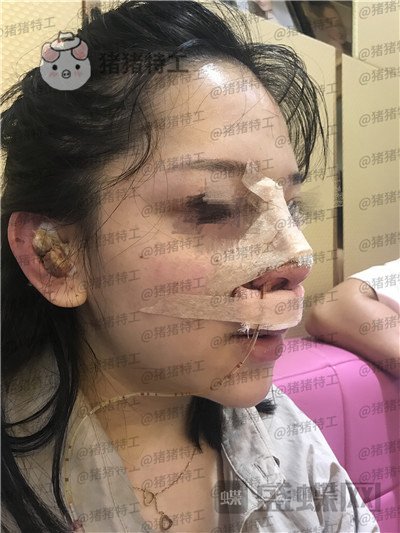 厦门福华,金贵香,鼻部手术,案例,价格,