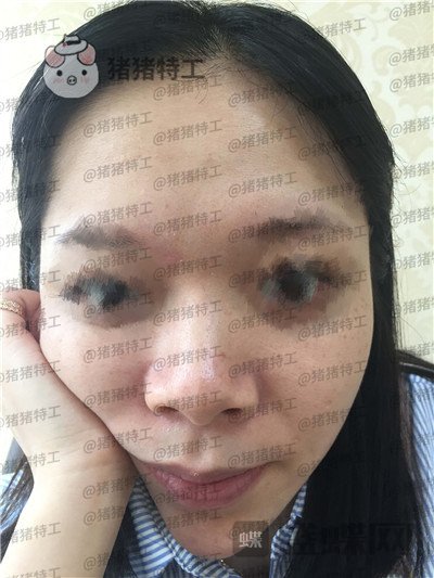 厦门福华,金贵香,鼻部手术,案例,价格,