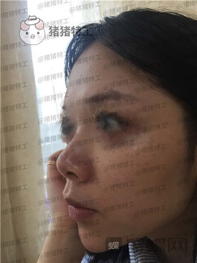 厦门福华,金贵香,鼻部手术,案例,价格,